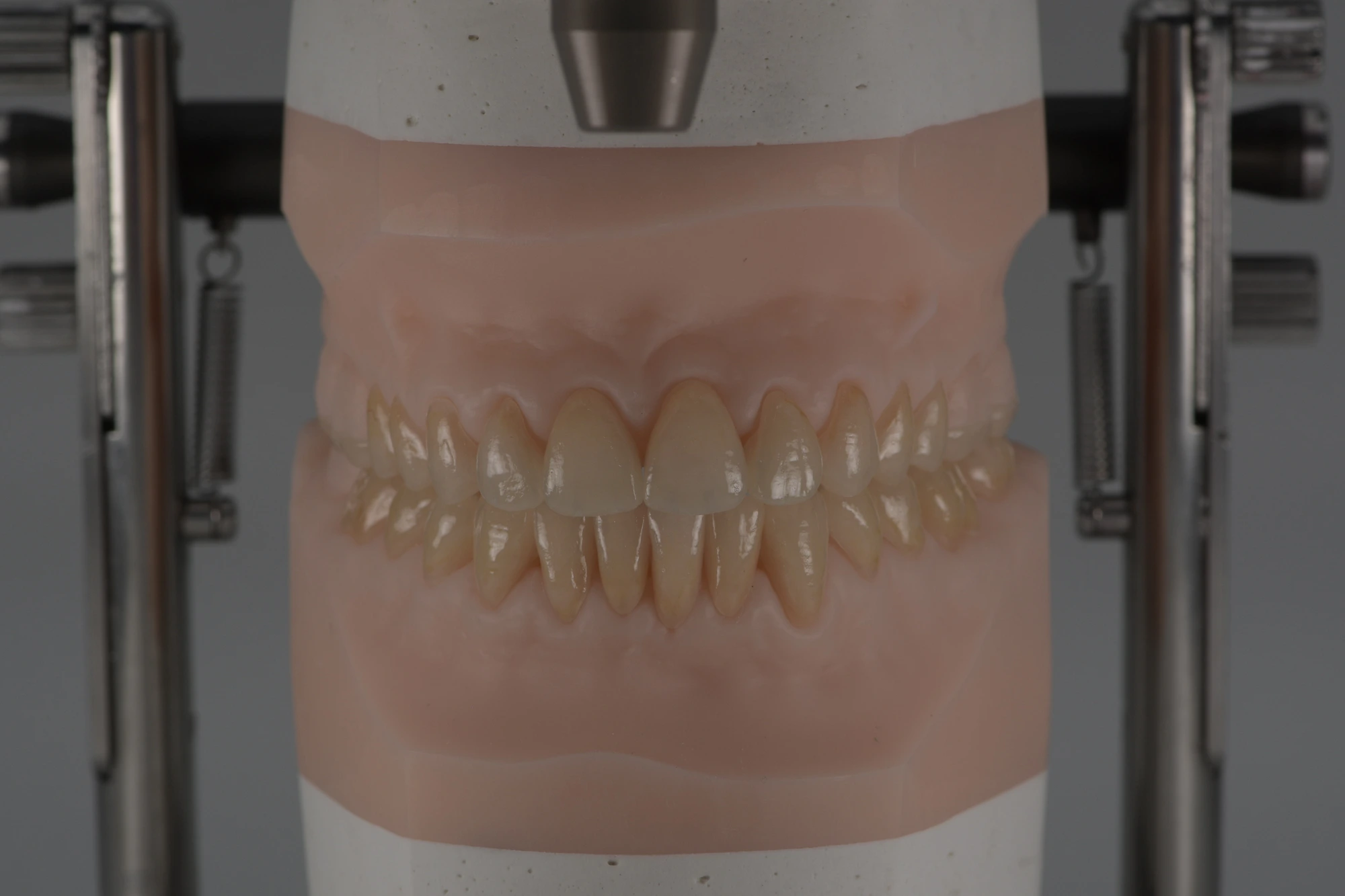 Ceramica anteriore - dettaglio estetico